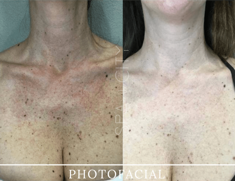chest photofacial