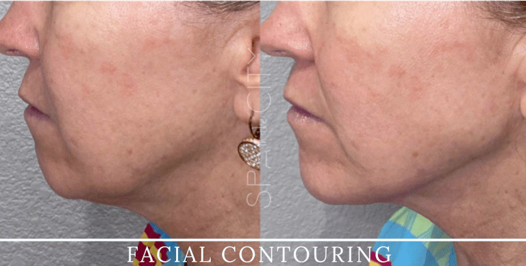 combination of Radiesse