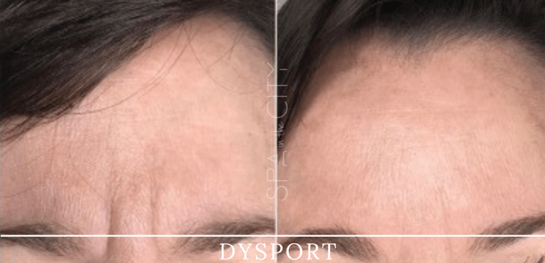 dysport BEFORE & AFTER