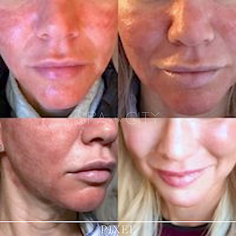 laser resurfacing before and after