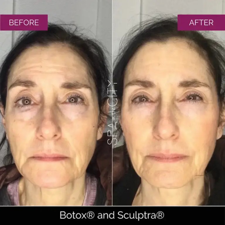 Botox and Sculptra before and after