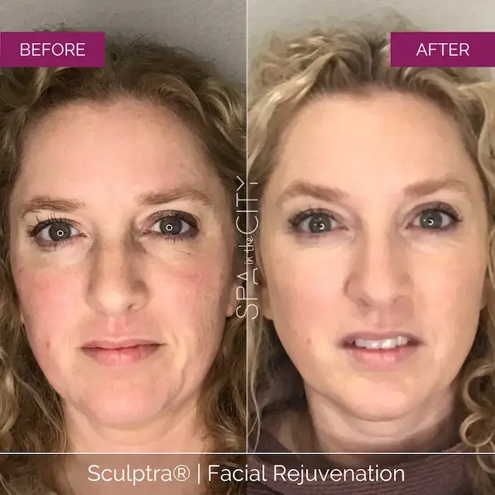 Sculptra facial rejuvenation before and after