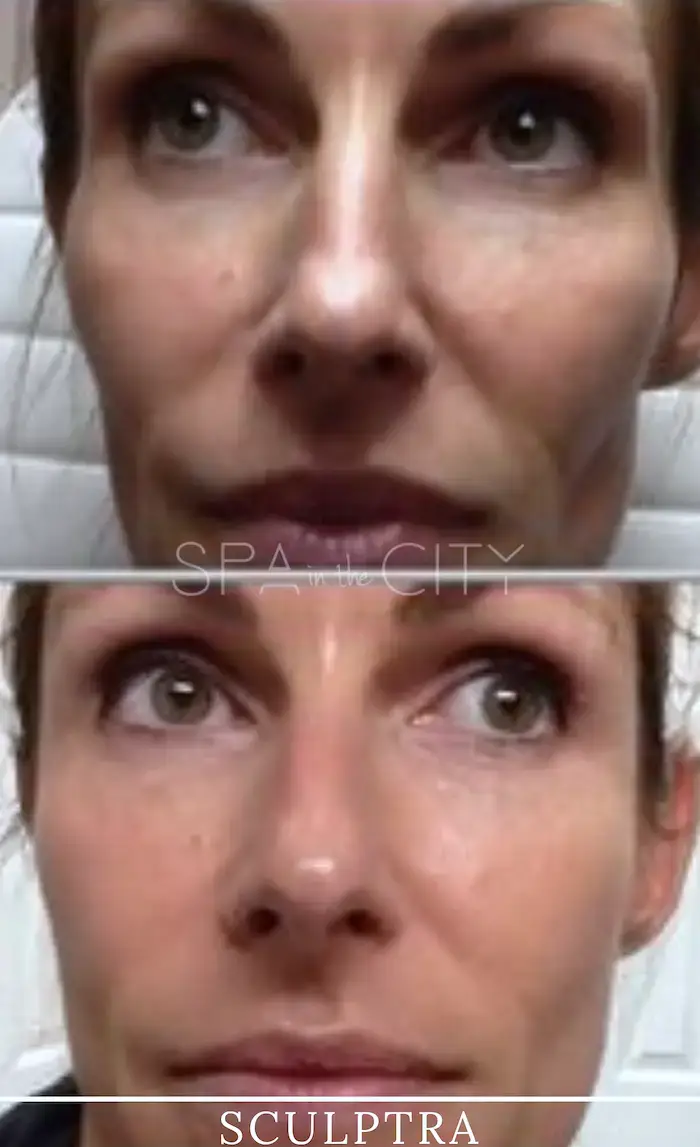 Sculptra facial rejuvenation results before after