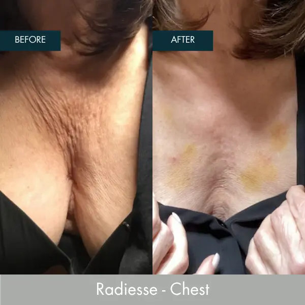 radiesse chest